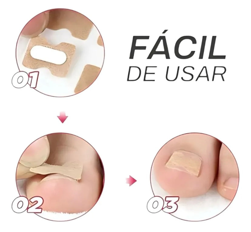 PARCHES UÑAS ENCARNADAS